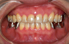 すきっ歯（空隙歯列）治療後