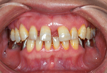 すきっ歯（空隙歯列）治療前